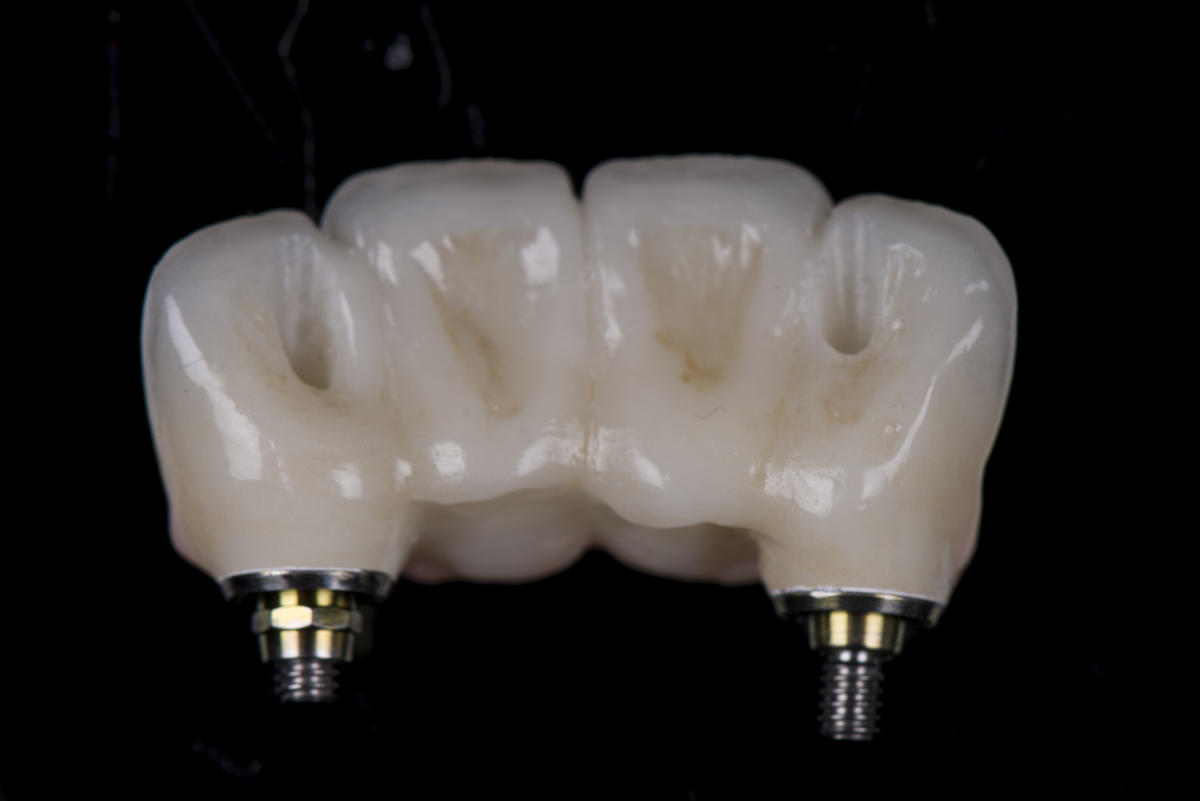 Pink Esthetics - Kwalident Dental Studio